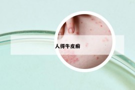 人得牛皮癬