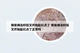 銀屑病治好后又開始起紅點了 銀屑病治好后又開始起紅點了正常嗎