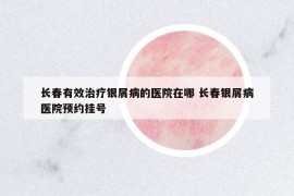 長春有效治療銀屑病的醫(yī)院在哪 長春銀屑病醫(yī)院預約掛號