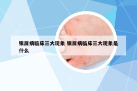 銀屑病臨床三大現(xiàn)象 銀屑病臨床三大現(xiàn)象是什么