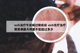 uvb治療牛皮癬過敏反應(yīng) uvb光療治療銀屑病最大劑量不能超過多少
