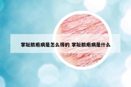 掌趾膿皰病是怎么得的 掌趾膿皰病是什么