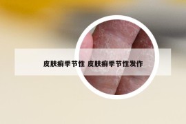 皮膚癬季節(jié)性 皮膚癬季節(jié)性發(fā)作
