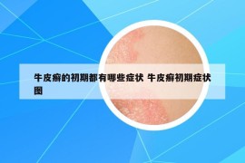 牛皮癬的初期都有哪些癥狀 牛皮癬初期癥狀圖