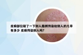皮癬部位碰了一下別人胳膊傳染給別人的幾率有多少 皮癬傳染別人嗎?