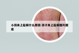 小孩身上起癬什么原因 孩子身上起癬圖片圖庫