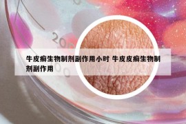 牛皮癬生物制劑副作用小時(shí) 牛皮皮癬生物制劑副作用