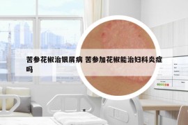 苦參花椒治銀屑病 苦參加花椒能治婦科炎癥嗎