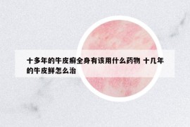 十多年的牛皮癬全身有該用什么藥物 十幾年的牛皮鮮怎么治