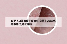 白蘿卜功效治療牛皮癬嗎 白蘿卜,皮膚病,能不能吃,可以吃嗎