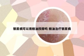 銀屑病可以用精油按摩嗎 精油治療銀屑病