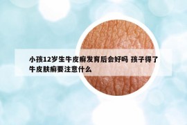小孩12歲生牛皮癬發(fā)育后會好嗎 孩子得了牛皮膚癬要注意什么