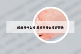起癬用什么擦 起癬用什么擦好得快