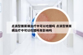點(diǎn)滴型銀屑病治療中可以吃醋嗎 點(diǎn)滴型銀屑病治療中可以吃醋嗎有影響嗎