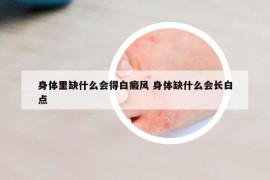 身體里缺什么會得白癜風(fēng) 身體缺什么會長白點(diǎn)