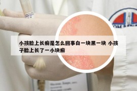 小孩臉上長癬是怎么回事白一塊黑一塊 小孩子臉上長了一小塊癬