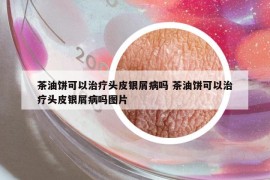 茶油餅可以治療頭皮銀屑病嗎 茶油餅可以治療頭皮銀屑病嗎圖片