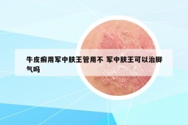 牛皮癬用軍中膚王管用不 軍中膚王可以治腳氣嗎