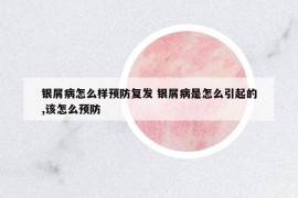 銀屑病怎么樣預(yù)防復(fù)發(fā) 銀屑病是怎么引起的,該怎么預(yù)防