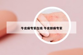牛皮癬專家在線 牛皮膚癬專家