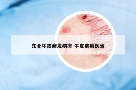 東北牛皮癬發(fā)病率 牛皮病癬醫(yī)治