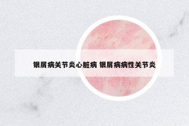 銀屑病關(guān)節(jié)炎心臟病 銀屑病病性關(guān)節(jié)炎