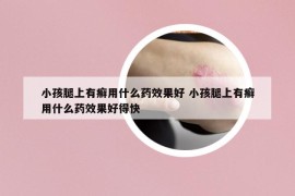 小孩腿上有癬用什么藥效果好 小孩腿上有癬用什么藥效果好得快