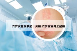 六歲女童皮膚起一片癬 六歲寶寶身上起癬