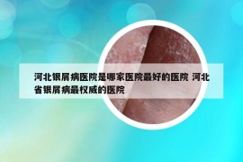 河北銀屑病醫(yī)院是哪家醫(yī)院最好的醫(yī)院 河北省銀屑病最權(quán)威的醫(yī)院