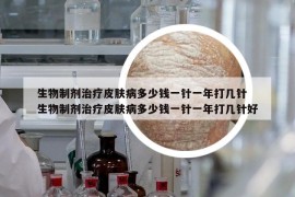 生物制劑治療皮膚病多少錢一針一年打幾針 生物制劑治療皮膚病多少錢一針一年打幾針好