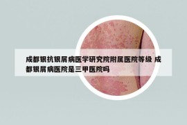 成都銀抗銀屑病醫(yī)學(xué)研究院附屬醫(yī)院等級 成都銀屑病醫(yī)院是三甲醫(yī)院嗎