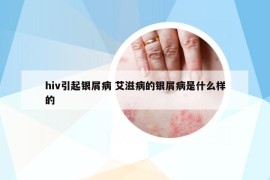hiv引起銀屑病 艾滋病的銀屑病是什么樣的