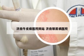 濟南牛皮癬醫(yī)院網(wǎng)站 濟南銀屑病醫(yī)院