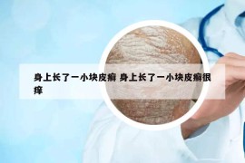 身上長了一小塊皮癬 身上長了一小塊皮癬很癢