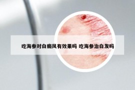 吃海參對(duì)白癜風(fēng)有效果嗎 吃海參治白發(fā)嗎
