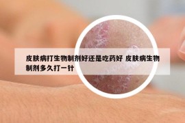 皮膚病打生物制劑好還是吃藥好 皮膚病生物制劑多久打一針