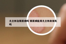 凡士林治銀屑病嗎 銀屑病能用凡士林身體乳嗎