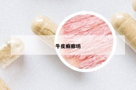 牛皮癬廊坊