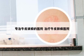 專治牛皮頑癬的醫(yī)院 治療牛皮膚癬醫(yī)院