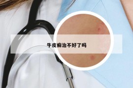 牛皮癬治不好了嗎