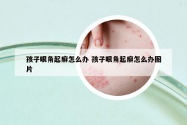 孩子眼角起癬怎么辦 孩子眼角起癬怎么辦圖片