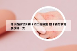 他卡西醇軟膏和卡泊三醇區(qū)別 他卡西醇軟膏多少錢一支