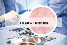干癬是什么 干癬是什么病