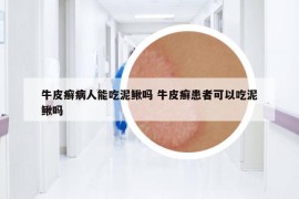 牛皮癬病人能吃泥鰍嗎 牛皮癬患者可以吃泥鰍嗎