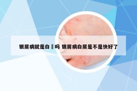 銀屑病就是白疕嗎 銀屑病白屑是不是快好了