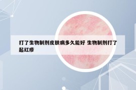 打了生物制劑皮膚病多久能好 生物制劑打了起紅疹