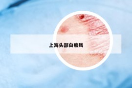 上海頭部白癜風(fēng)