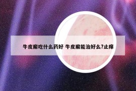 牛皮廨吃什么藥好 牛皮廨能治好么?止癢