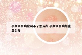 孕期銀屑病控制不了怎么辦 孕期銀屑病加重怎么辦