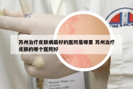 蘇州治療皮膚病最好的醫(yī)院是哪里 蘇州治療皮膚的哪個(gè)醫(yī)院好